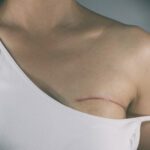 يعتبر استئصال الثدي بسبب السرطان إجراء جراحيا يتم فيه إزالة جزء أو كل الثدي لعلاج سرطان الثدي